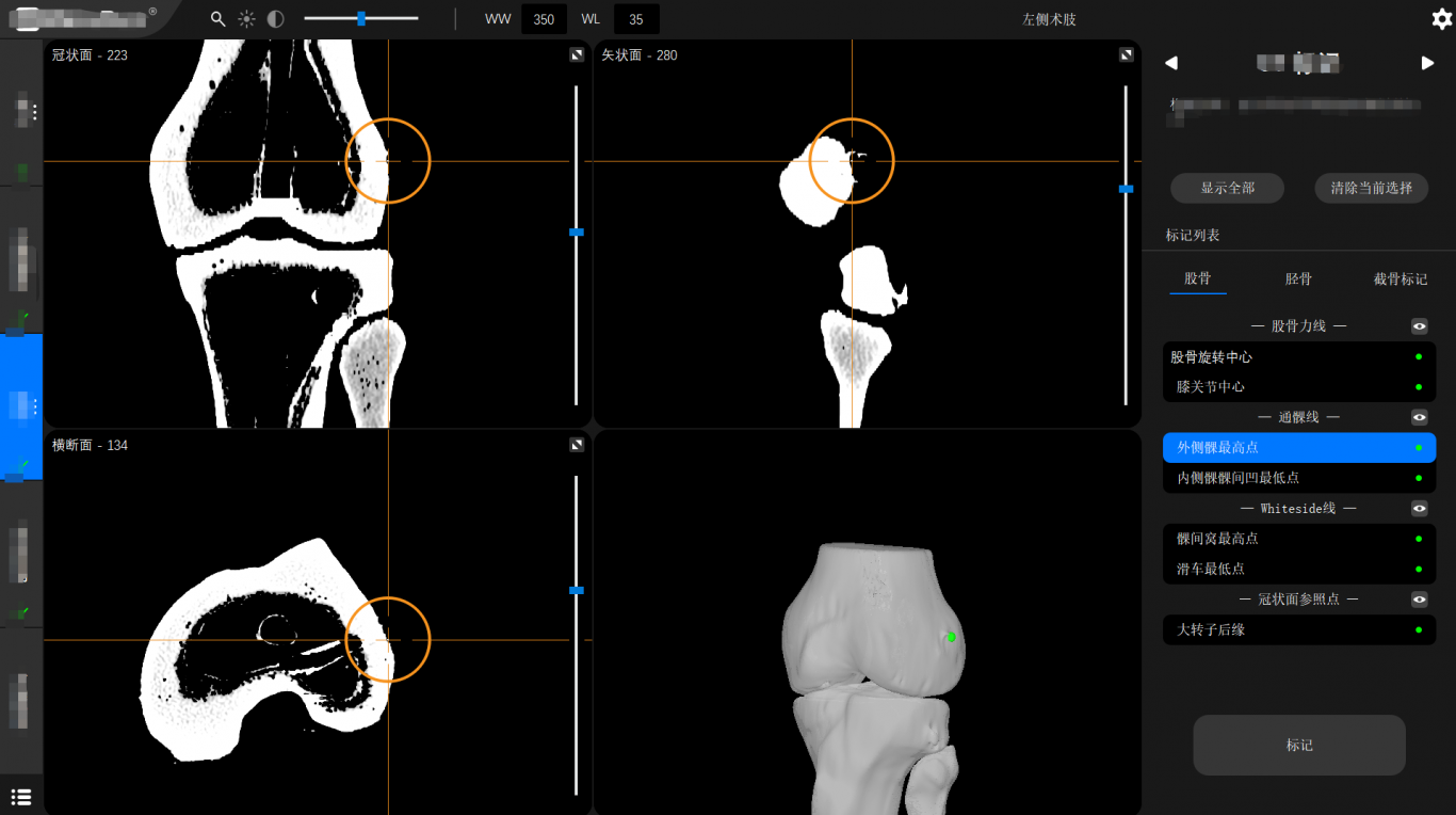 膝关节置换导航手术机器人系统