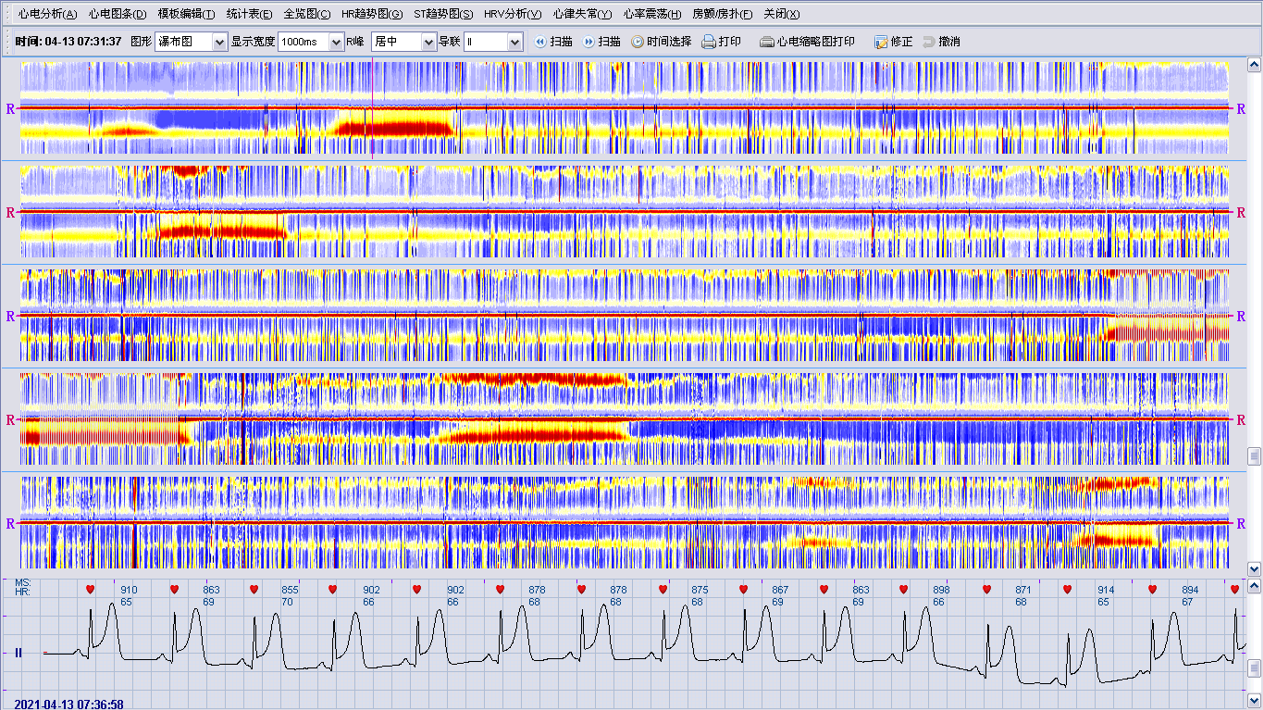 动态心电血压阅图分析软件