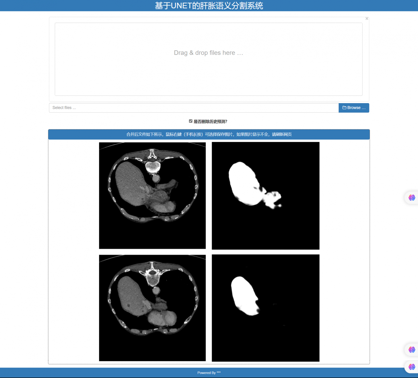 基于Unet的肝胀CT图像语义分割系统
